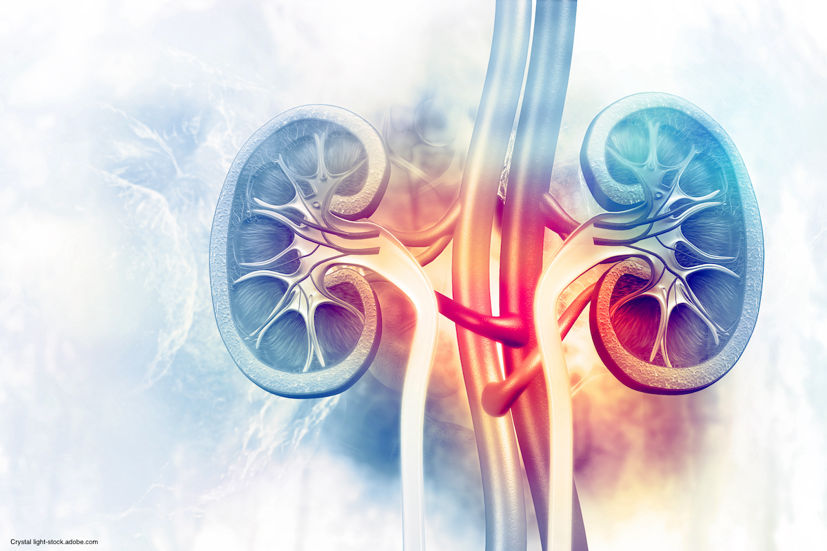 Combo of burst wave lithotripsy and ultrasonic propulsion feasible for kidney stones
