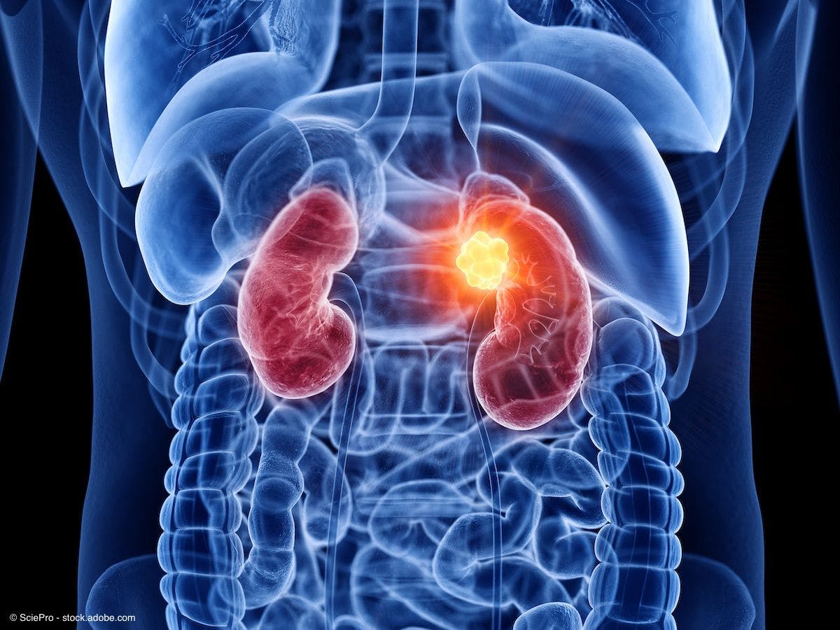 The single-center, investigator-initiated, phase 2 trial consisted of 2 genomically selected advanced kidney cancer cohorts.