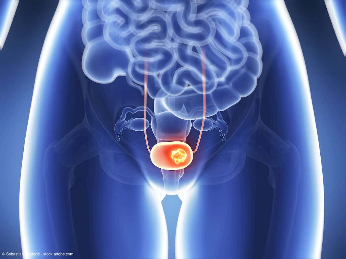 3d rendered illustration - bladder cancer | Image Credit: © Sebastian Kaulitzki - stock.adobe.com 
