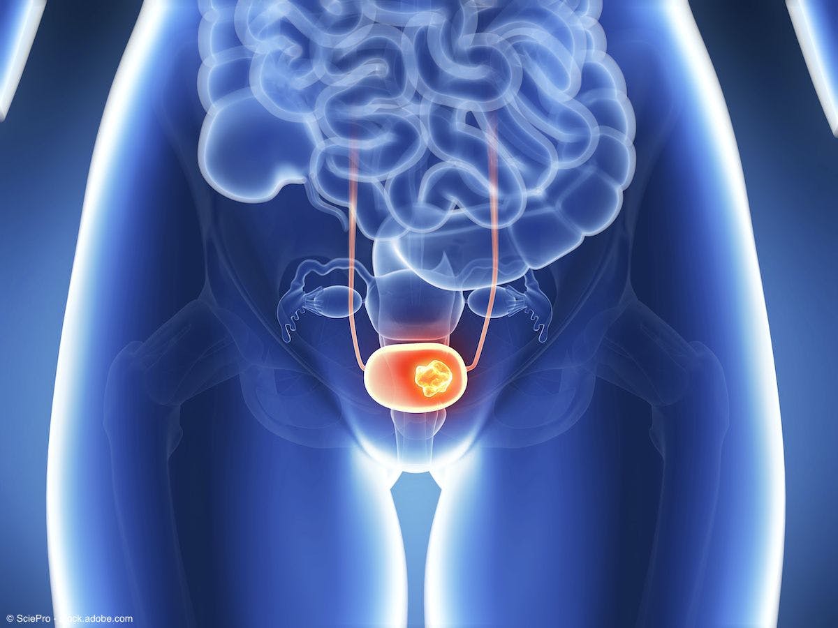 3d rendered illustration bladder cancer | Image Credit: © SciePro - stock.adobe.com