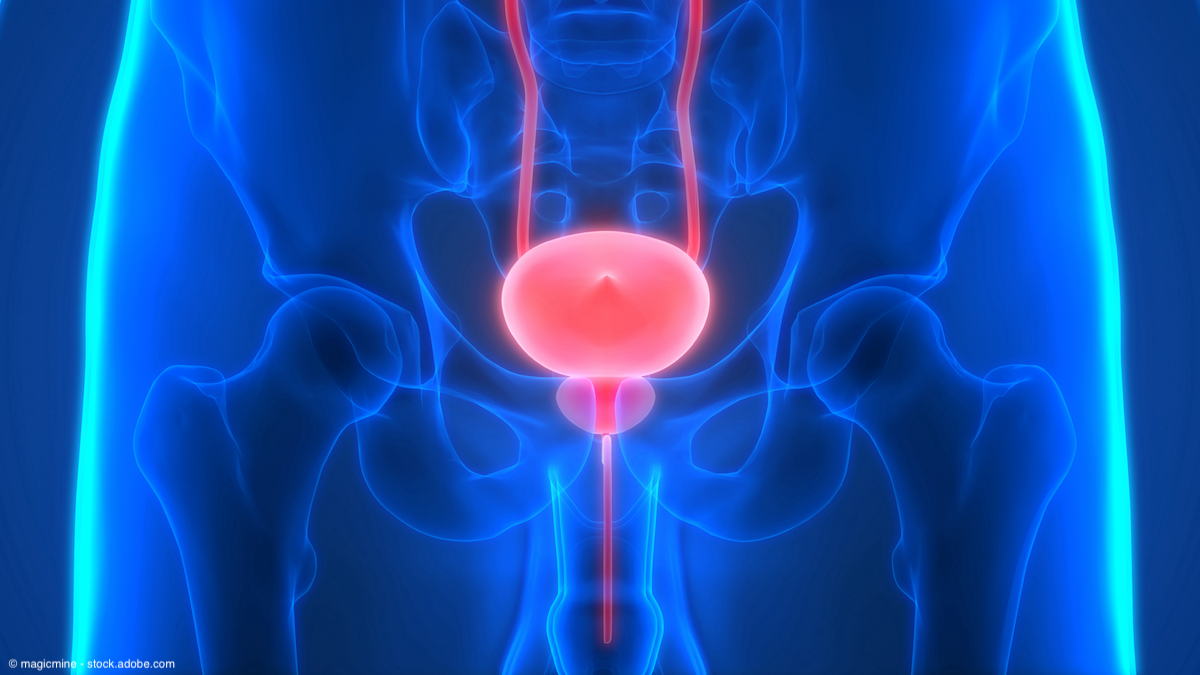 Combo of cabozantinib and pembrolizumab shows promise in frontline urothelial carcinoma