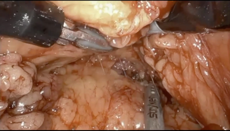 A urologist shares his experience with retroperitoneal single-port robotic surgery