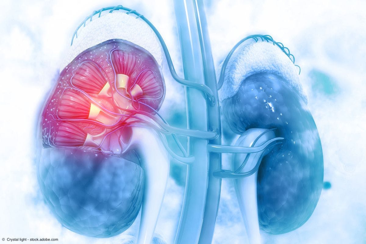 Based on previously reported data from KEYNOTE-564, the FDA approved pembrolizumab for the adjuvant treatment of patients with RCC at intermediate-high or high risk of recurrence following nephrectomy, or following nephrectomy and resection of metastatic lesions.