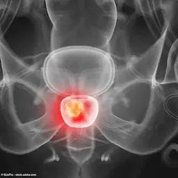 Adding higher radiation dose to long-term ADT linked to survival boost in prostate cancer