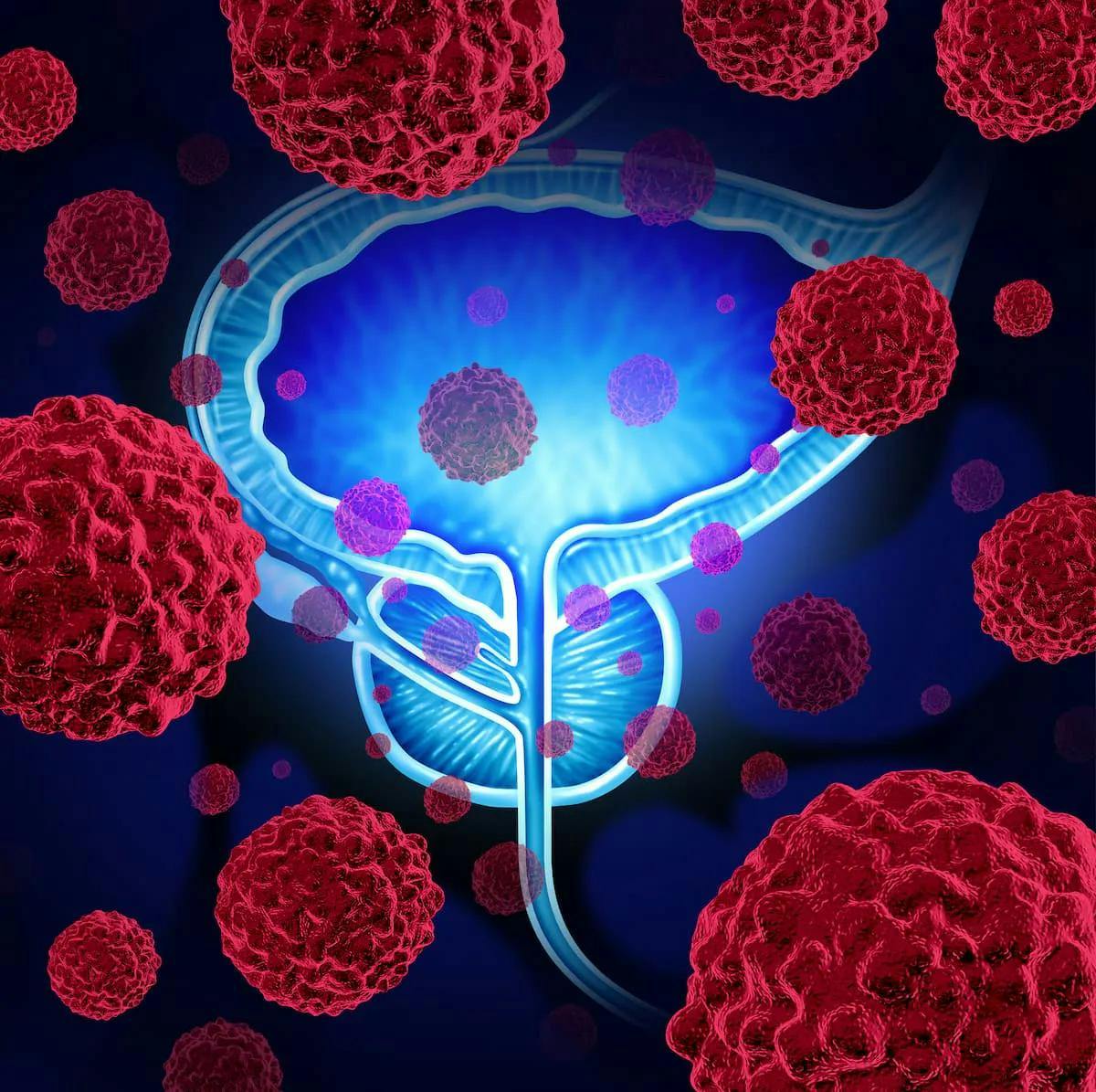 Study shows HIFU noninferior to prostatectomy for localized prostate cancer