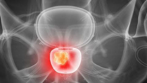 Study identifies prostate cancer subgroup likely to benefit from adjuvant radiotherapy 
