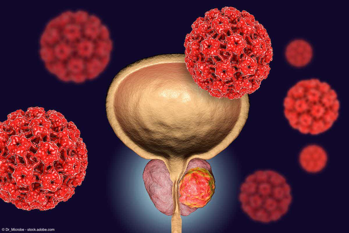 Illustration of prostate cancer | Image Credit: © Dr_Microbe - stock.adobe.com