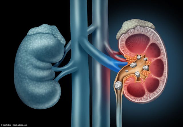 Ultrasonic propulsion for clearance of residual kidney stone fragments reduces relapse