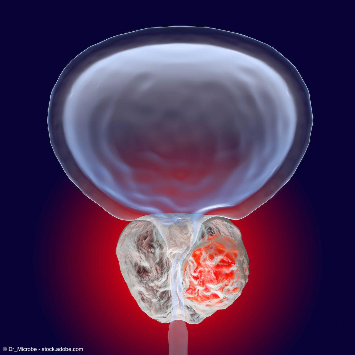 PSMA levels linked to tumor biology, treatment sensitivity in treatment-naïve prostate cancer