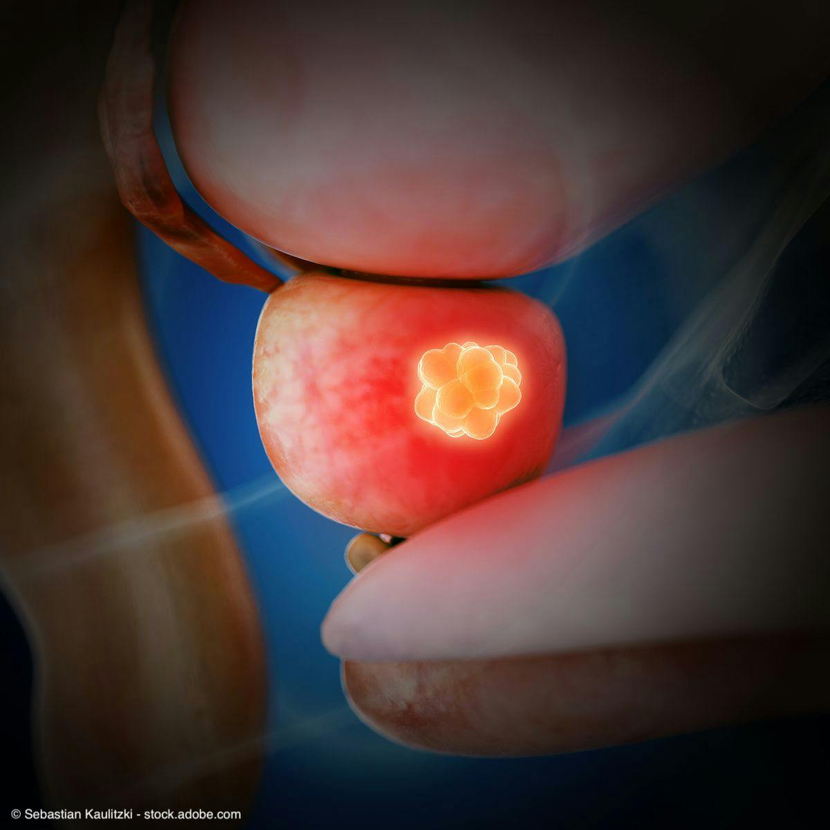 3d rendered illustration of prostate cancer | Image Credit: © Sebastian Kaulitzki - stock.adobe.com 