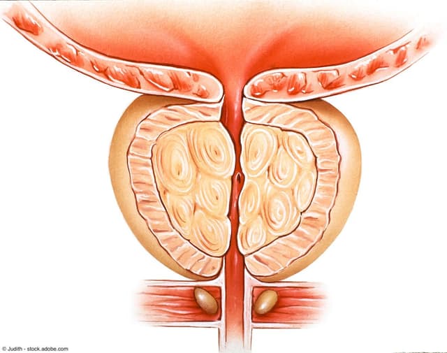 Benign Prostatic Hyperplasia | Image Credit: © Judith - stock.adobe.com