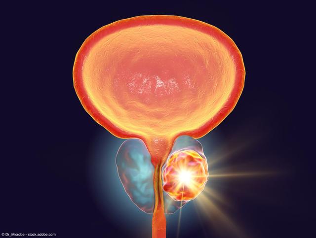 High Decipher score is predictive of docetaxel benefit in advanced prostate cancer