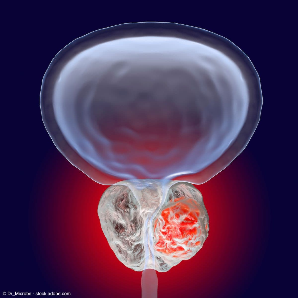 Prostate cancer 3D illustration | Image Credit: © Dr_Microbe - stock.adobe.com