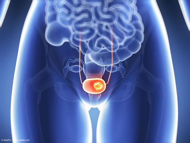 medical depiction of bladder cancer on xray