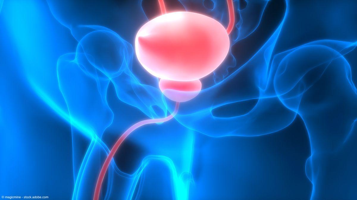 Plasma ctDNA clearance may be associated with improved outcomes in MIBC