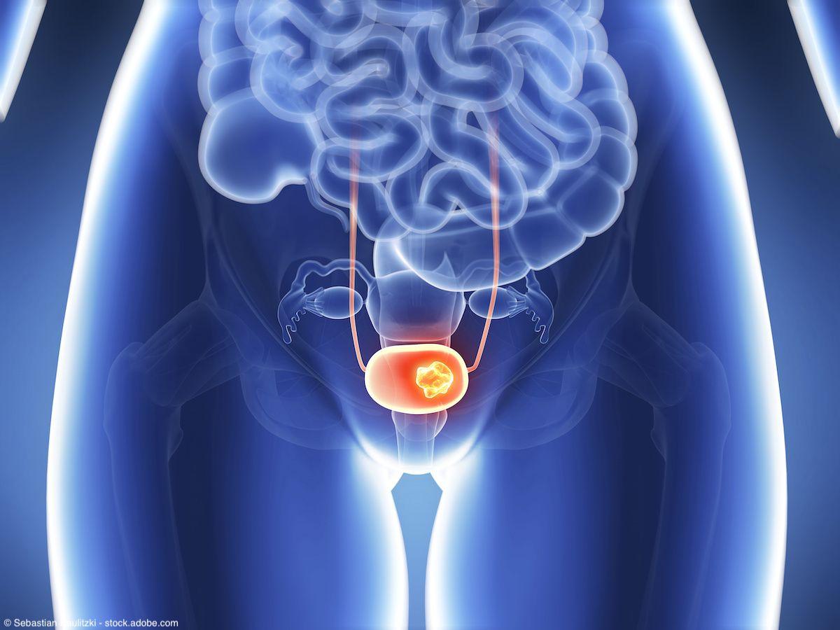 3d illustration of bladder cancer | Image Credit: © Sebastian Kaulitzki - stock.adobe.com