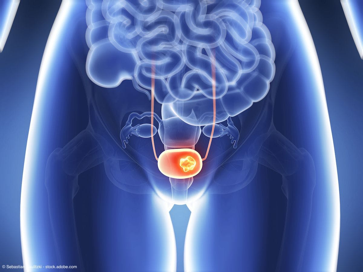 3d rendered illustration - bladder cancer | Image Credit: © Sebastian Kaulitzki - stock.adobe.com 